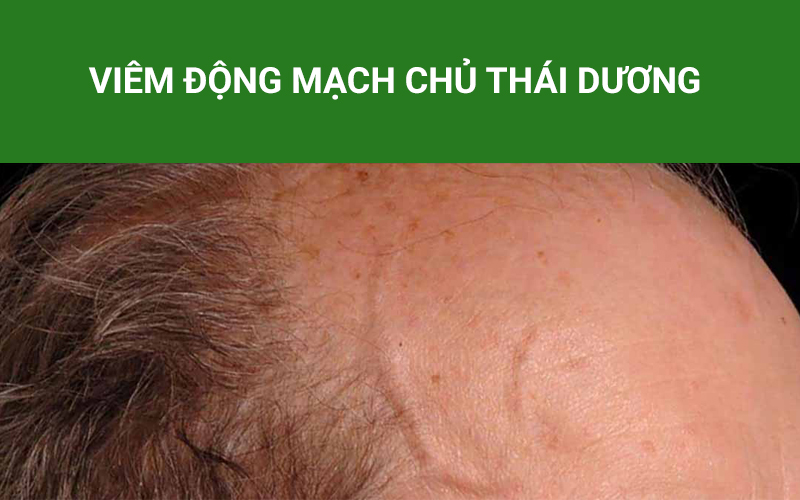 Bệnh viêm động mạch thái dương 