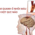 viem quanh o nhoi mau sau dot quy nao