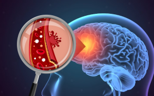 Thiếu máu não là một trong những nguyên nhân chính gây đau đầu mãn tính