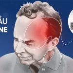 dau-dau-migraine (1)