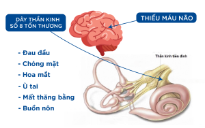 Rối loạn tiền đình là do máu lên não ít, thiếu máu não