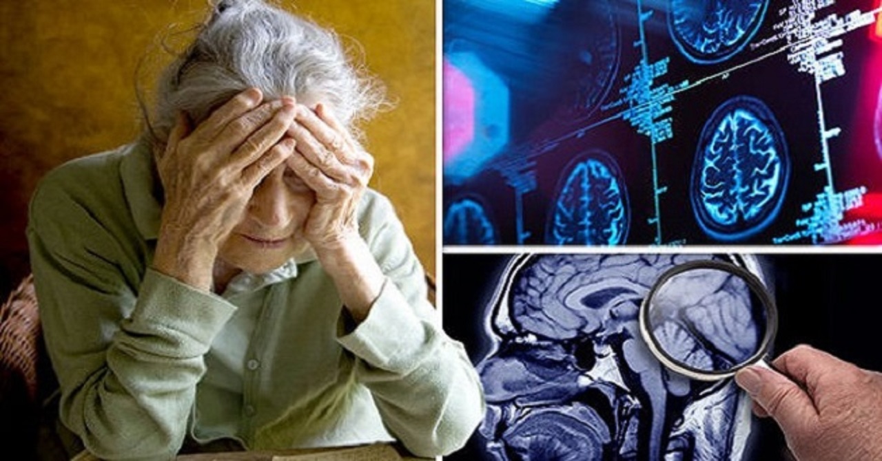Ảnh: Trung bình người bệnh Alzheimer sống được bao lâu?