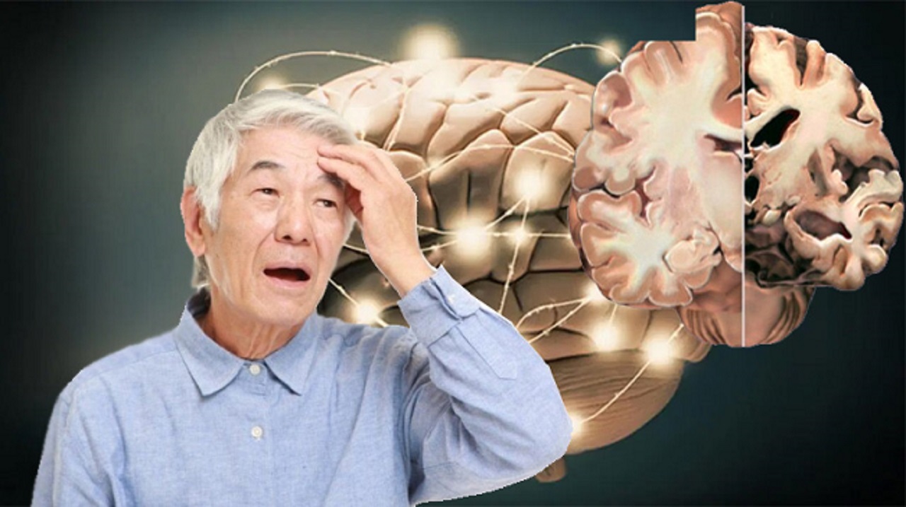 Bệnh Alzheimer là gì? Nguyên nhân, triệu chứng và những kiến thức cần nắm rõ hoi-chung-alzheimer-la-gi-1-1.jpg
