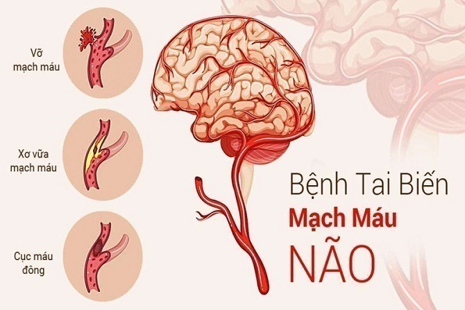 Tai biến mạch máu não là một bệnh lý hết sức nguy hiểm tới tính mạng