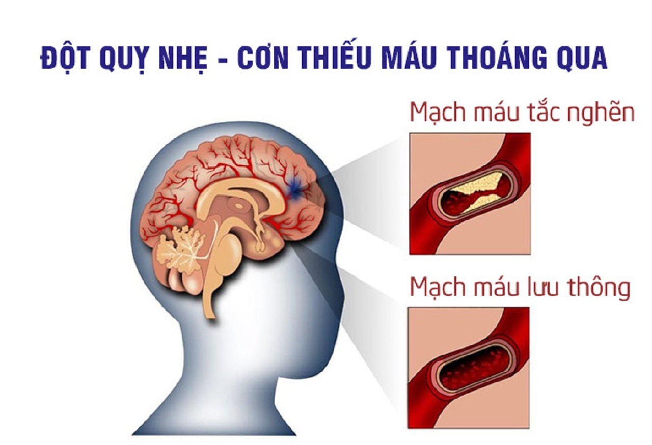 Xử lý đột quỵ nhẹ giảm các tổn thương não bộ