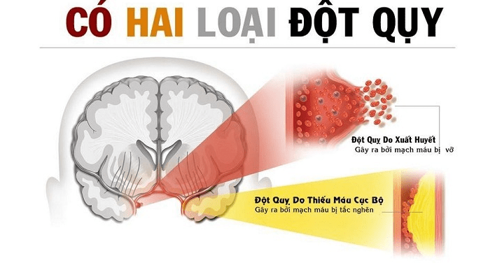 Ảnh: Phân loại tai biến mạch máu não 