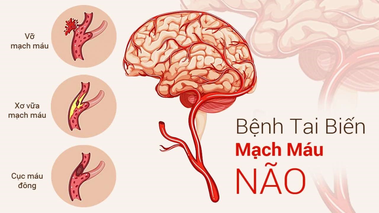 nguyên nhân gây tai biến ở người già