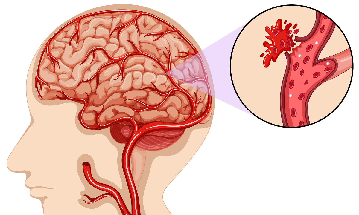 Hai nguyên nhân chính gây đột quỵ là tắc mạch máu và vỡ mạch máu não