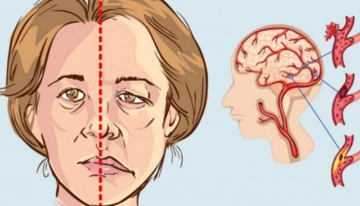 Tai biến nhẹ ở người già có nguy hiểm? Cách điều trị và phòng ngừa tai biến nhẹ ở người già có nguy hiểm
