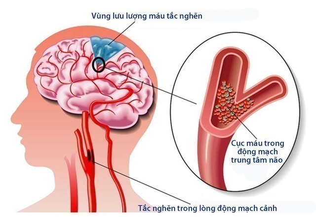 tại sao cần vật lý trị liệu cho người bị tai biến