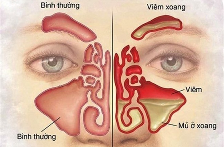 Các ổ viêm chảy dịch khiến các virus tấn công sang các vùng khác