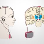 Phẫu thuật là một phương pháp giúp hạn chế các triệu chứng của bệnh Parkinson