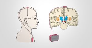 Phẫu thuật là một phương pháp giúp hạn chế các triệu chứng của bệnh Parkinson