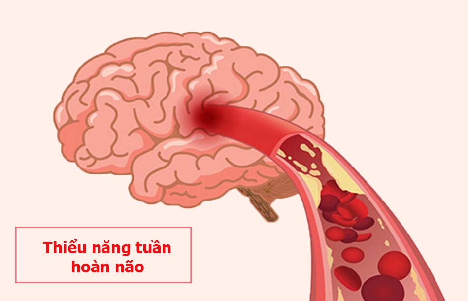 Thiểu năng tuần hoàn não gây ra các triệu chứng chóng mặt, mệt mỏi, suy giảm trí nhớ