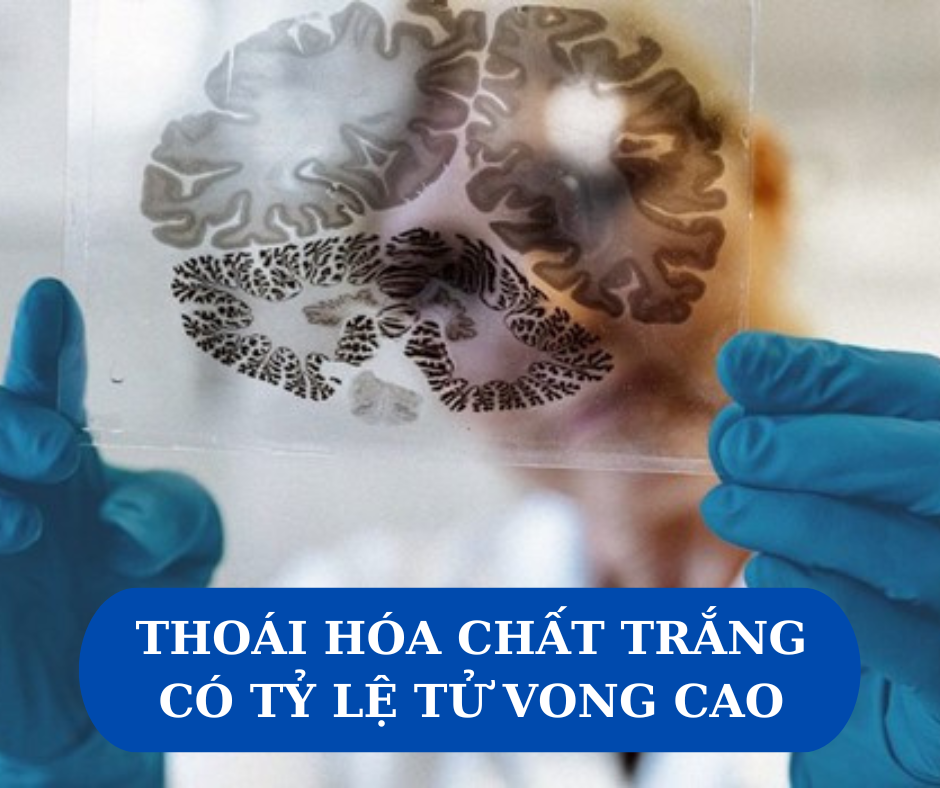 Thoái hóa chất trắng là bệnh lý nguy hiểm với tỷ lệ tử vong cao