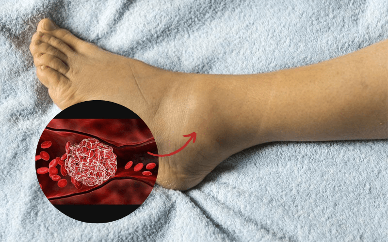 Dấu hiệu nhận biết cục máu đông có thể là đau nhức, sưng phù chân